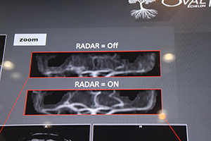 動きがあっても明瞭な血管画像を得られる“RADAR Time of Flight”