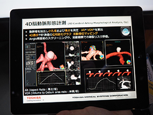 未破裂動脈瘤の評価に有用な4D脳動脈形態計測