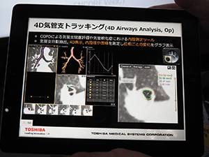 呼吸による動態の解析を行える4D気管支トラッキング