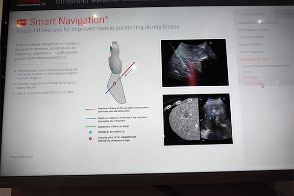 Smart NavigationはRFAにおいて仮想穿刺ラインを表示して手技を支援
