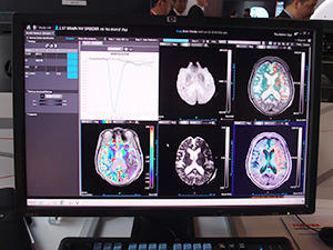 VitreaのMRI用アプリケーション“パーフュージョン解析”