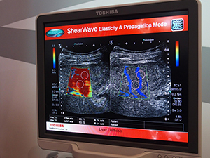 shear wave elastography用の“Propagation”