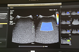 カラーマップで組織の硬さと信頼度が表示できるようになったShear Wave Elastography