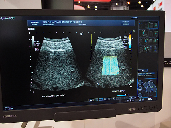 肝臓疾患に対する“Liver Package”を紹介。ATI（Atteuation Imaging）