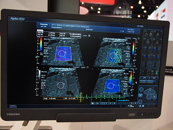 Shear Wave Elastography（SWE）＋SWDの表示