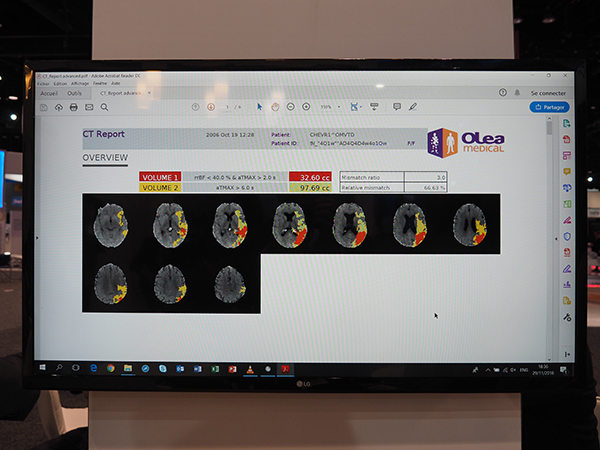 Olea Pulseを使うことでレポート作成，PACS転送などを自動化可能