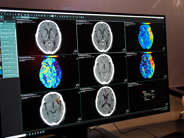 ブースでは頭部のCTパーフュージョンの自動処理をデモンストレーション