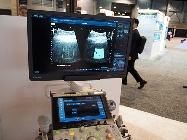 Aplio aシリーズにもAttenuation Imaging（ATI）を搭載