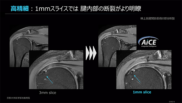 AiCEによりthin slice画像のノイズも良好に抑制