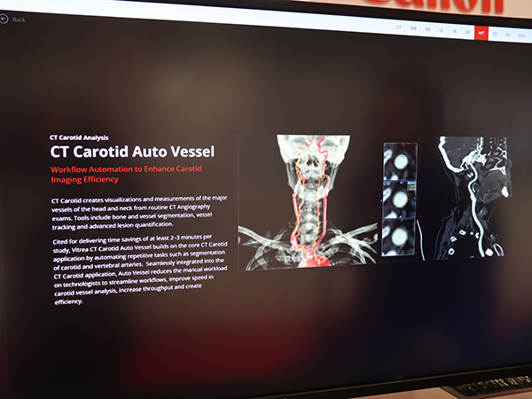 頸動脈解析を自動化する「Vitrea」の「CT Carotid Auto Vessel」