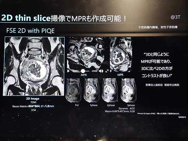 「PIQE」では2D thin slice撮像でMRPを作成可能