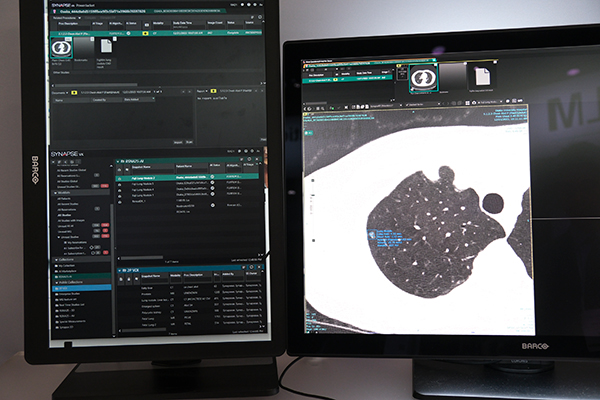 胸部病変検出用AI。日本では展開ずみで，レポーティングシステムとの連携も含め米国での実装に向け開発中。