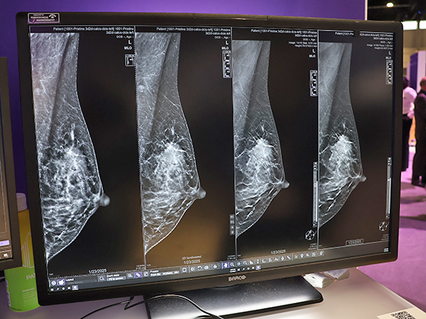 「Pristina Recon DL」（薬機法未承認）により微細な石灰化や腫瘤の描出能が向上