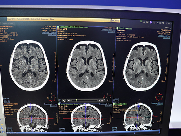 AI画像再構成「Spectral Precise Image」とMonoEで白質と灰白質のコントラストが向上（左：iDose4，中央：Spectral Precise Image・MonoE 66keV，右：Spectral Precise Image・MonoE 50keV）