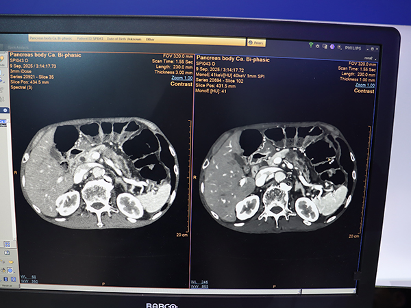 膵がんもSpectral Precise Imageにより明瞭化（左：iDose4・3mm，右：Spectral Precise Image・MonoE 41keV・1mm）