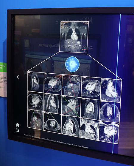 スライス断面を自動設定する「SmartHeart」