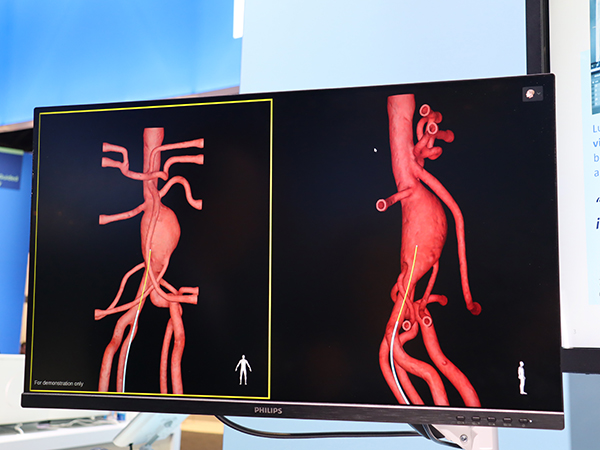 X線を使わない3Dデバイスガイダンス「LumiGuide」