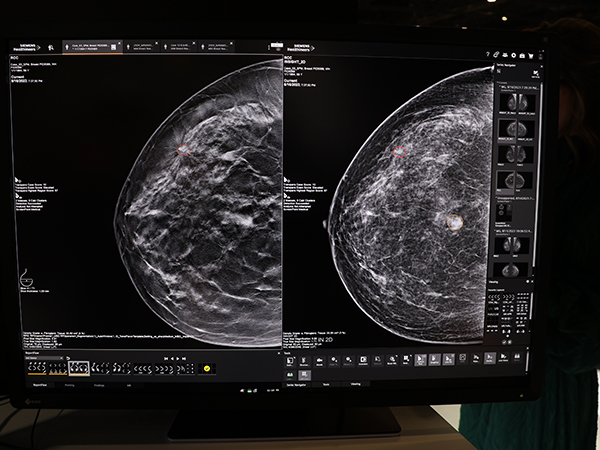 マンモビューワにScreenPoint社のCAD「Transpara Breast AI」を搭載し，正確かつ効率的な診断を支援