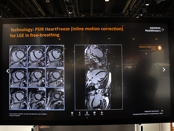 呼吸による動き補正技術「HeartFreeze」