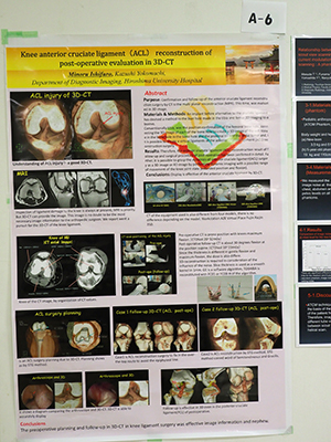 Magna Cum Laude Knee anterior ligament（ACL） reconstruction of post-operative evaluation in 3D-CT 石風呂　実 氏（広島大学病院）