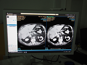 【フィリップスエレクトロニクスジャパン】「IntelliSpace Portal」による「IQon Spectral CT」のDual Energy解析画像を紹介。