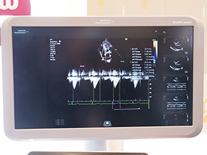 “eSie Measure”はワンクリックで心臓の自動計測が可能