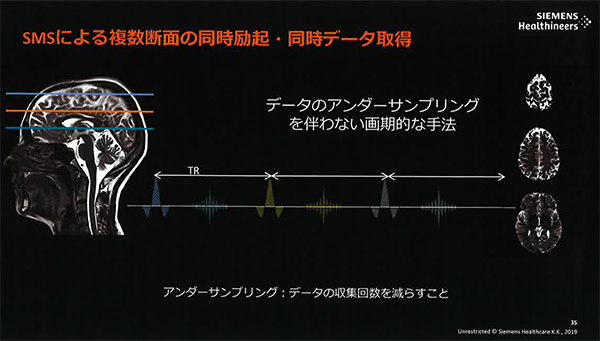 撮像時間を短縮し，MRI検査の生産性を高める“SMS”