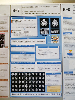 B（国内発表）：Cum Laude 舌癌CTにおける義歯の金属アーチファクトは開口位によって回避できる 永澤直樹 氏（三重大学医学部附属病院）ほか