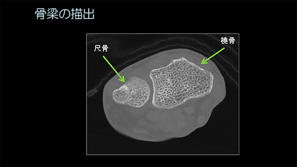 高精細画像による骨梁の構造の描出