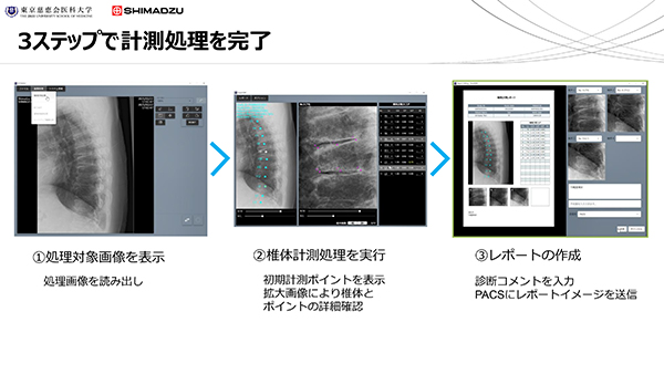 容易かつ効率的に椎体骨折を判定